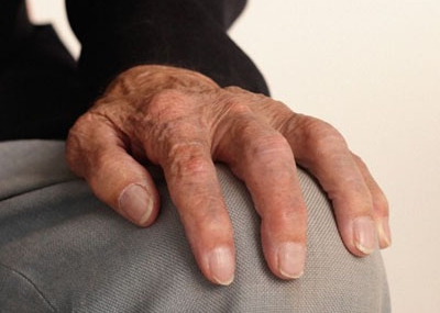 ¿Con Qué se Cura la Artritis Reumatoide?